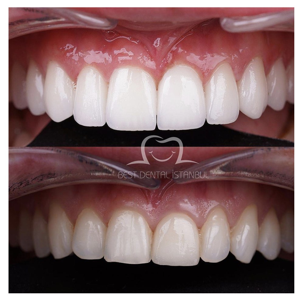 Best Dental Veneers in Turkey? Best Dental Clinic in Turkey LA Weekly